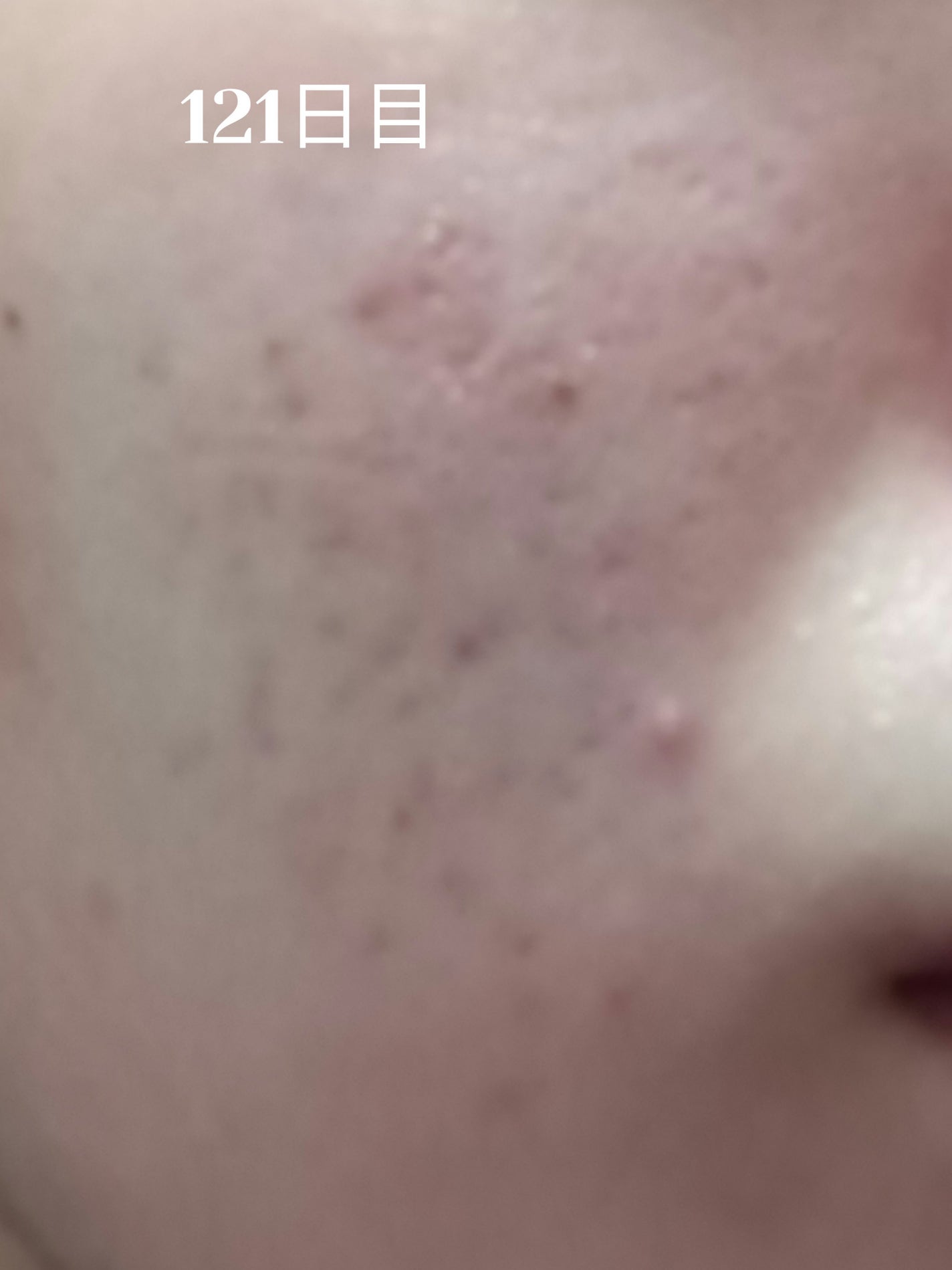 いぬ✢フォロバ100✢ on LIPS 「自分用ニキビ記録121日目3ヶ月経過!少し良くなってる..」(1枚目)