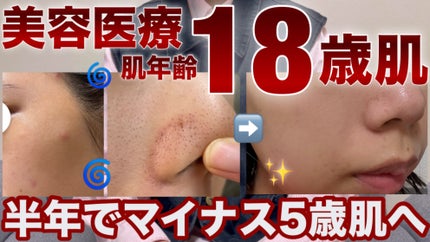 ãã¡ãð°ã¹ãã³ã±ã¢ããã on LIPS ãYouTubeæŽæ°ããŸããâ©.*Ë#çŸå®¹ç®èç§#çŸå®¹å»ç#ã¹ã..ãïŒ1æç®ïŒ