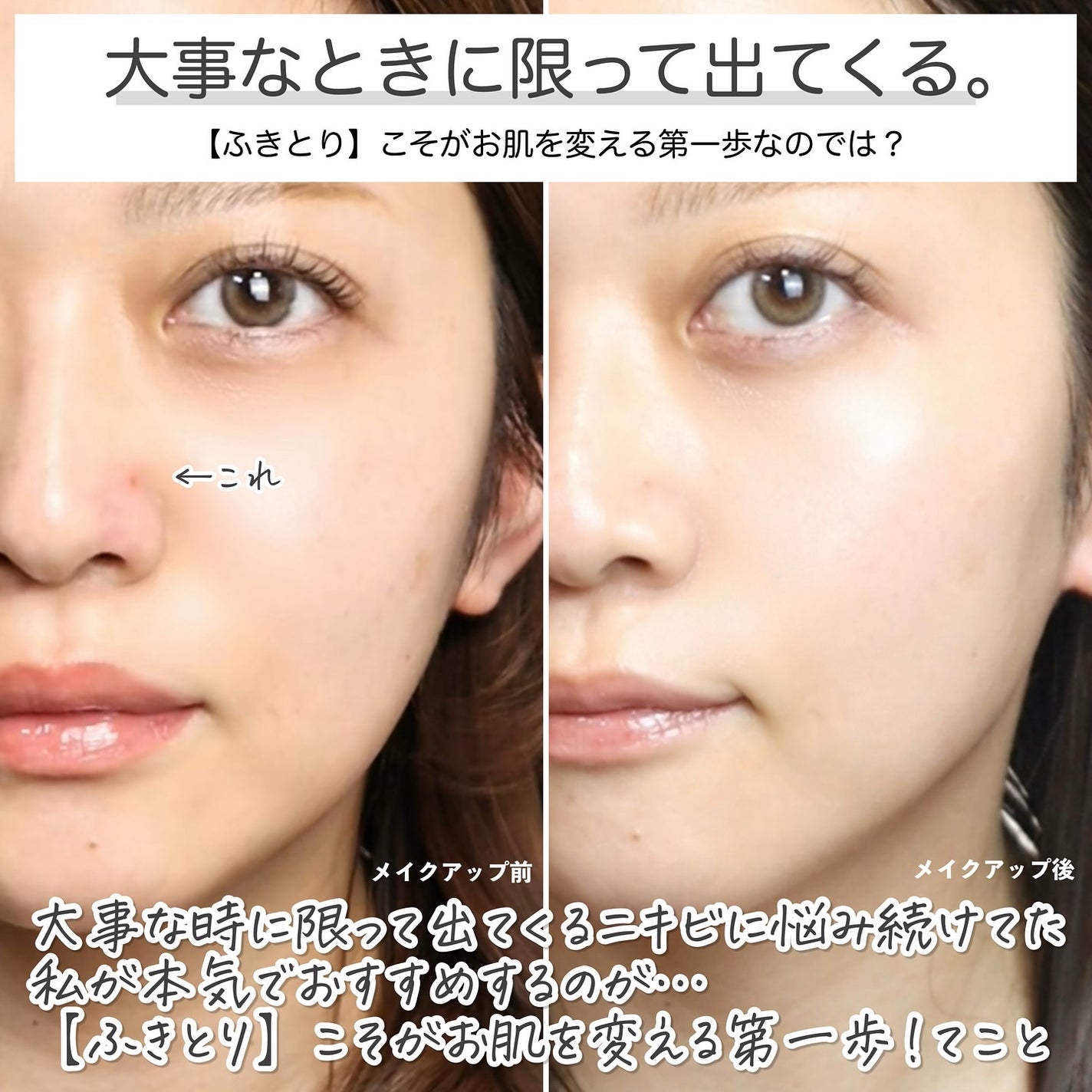 オードムーゲVC 薬用ふきとり化粧水/オードムーゲ/拭き取り化粧水を使ったクチコミ(2枚目)