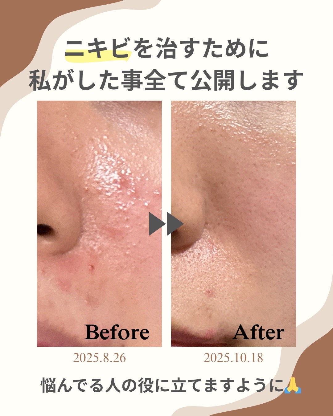 ペアアクネクリームW(医薬品)/ペア/その他を使ったクチコミ(1枚目)