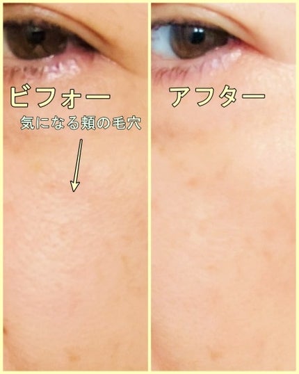 C×AZ ダーマインショット200/ESIENCE/美容液を使ったクチコミ(10枚目)