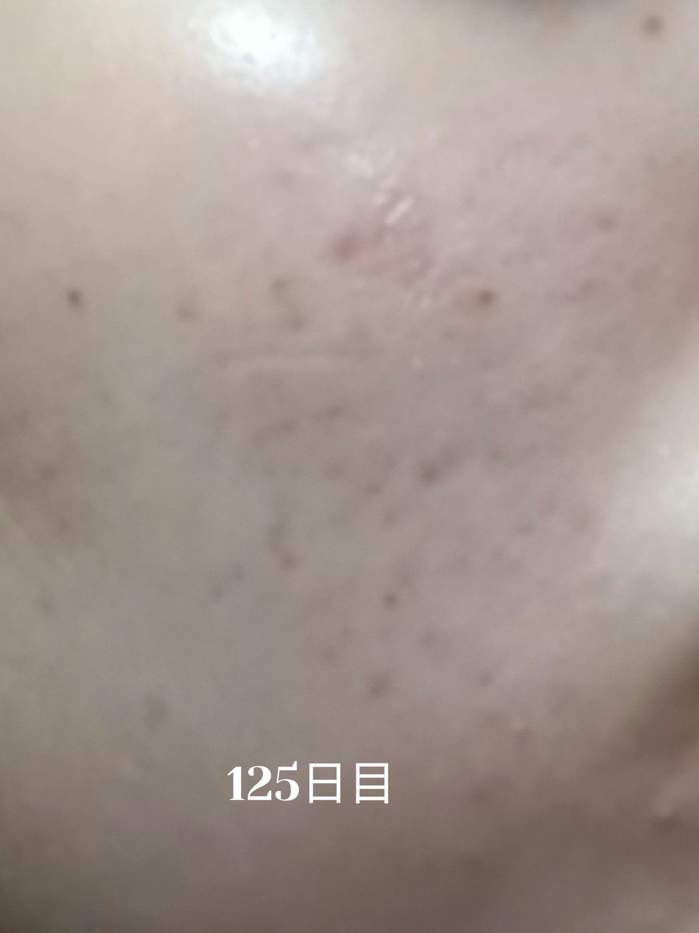 いぬ✢フォロバ100✢ on LIPS 「自分用ニキビ記録125日目ポツポツ新しいニキビできてるけど全体..」(1枚目)