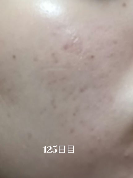 いぬ✢フォロバ100✢ on LIPS 「自分用ニキビ記録125日目ポツポツ新しいニキビできてるけど全体..」(1枚目)