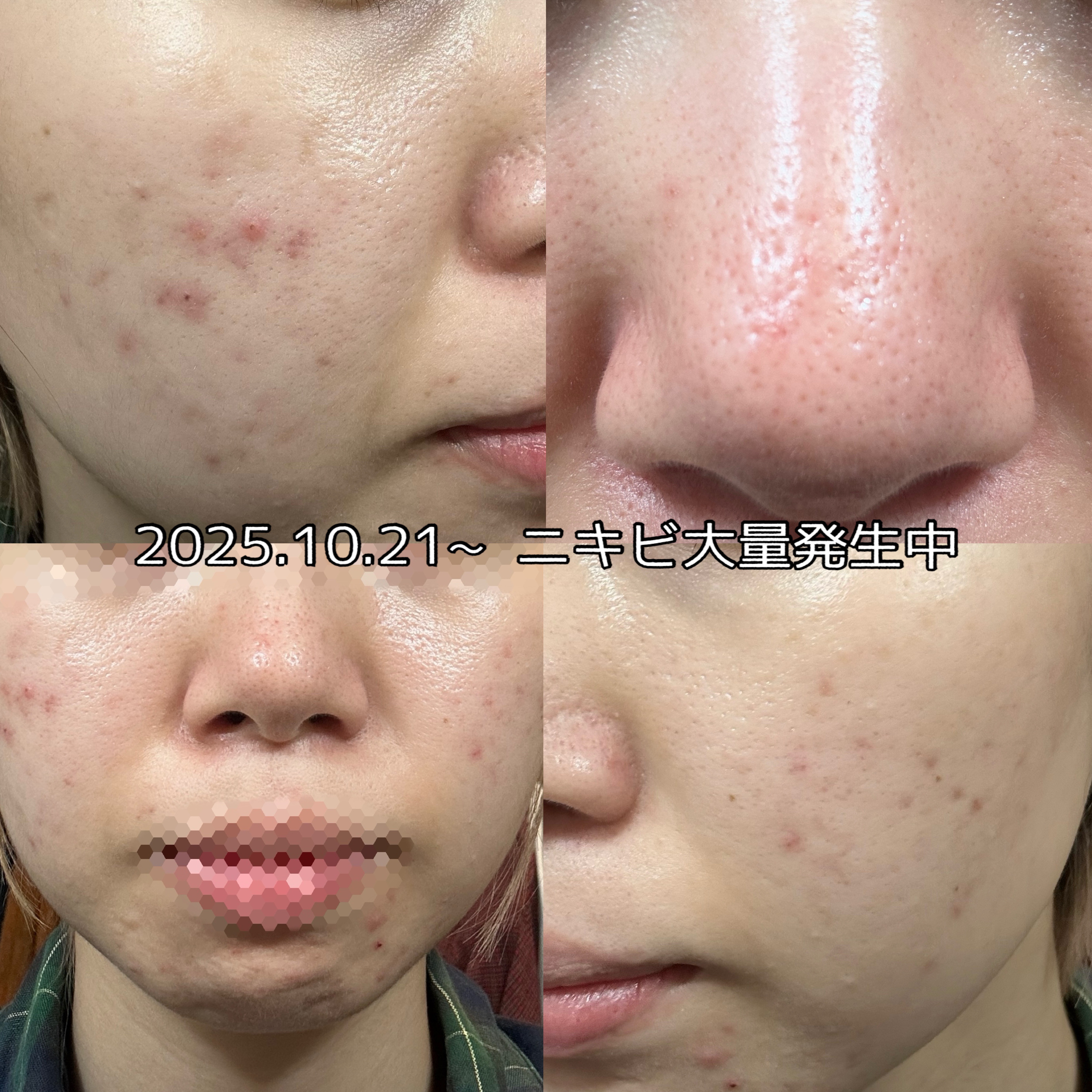 Ａ アクネジェル/NOV/美容液を使ったクチコミ（2枚目）