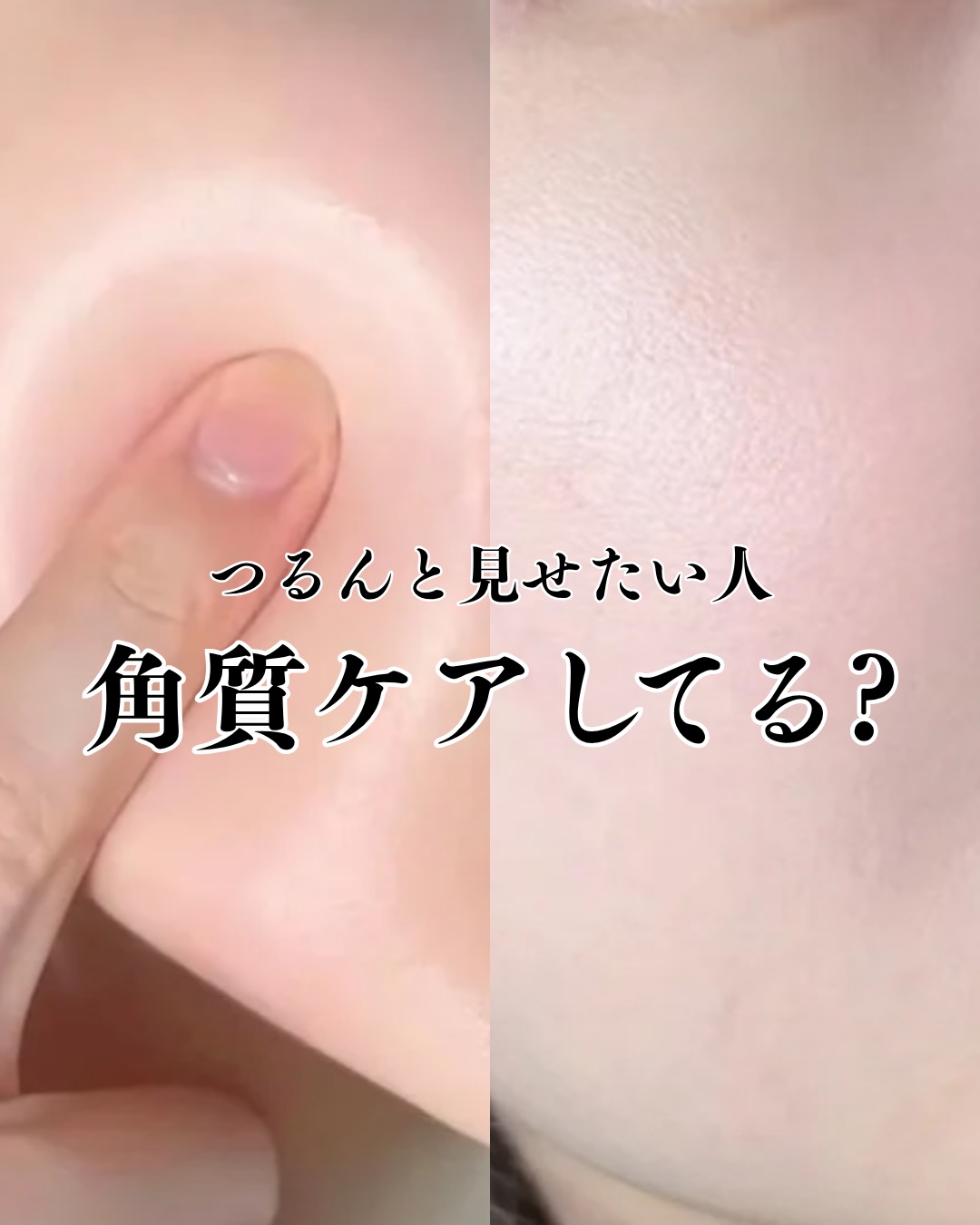 アネトス アクネケア トリートメント セラム/Anetos/美容液を使ったクチコミ（1枚目）