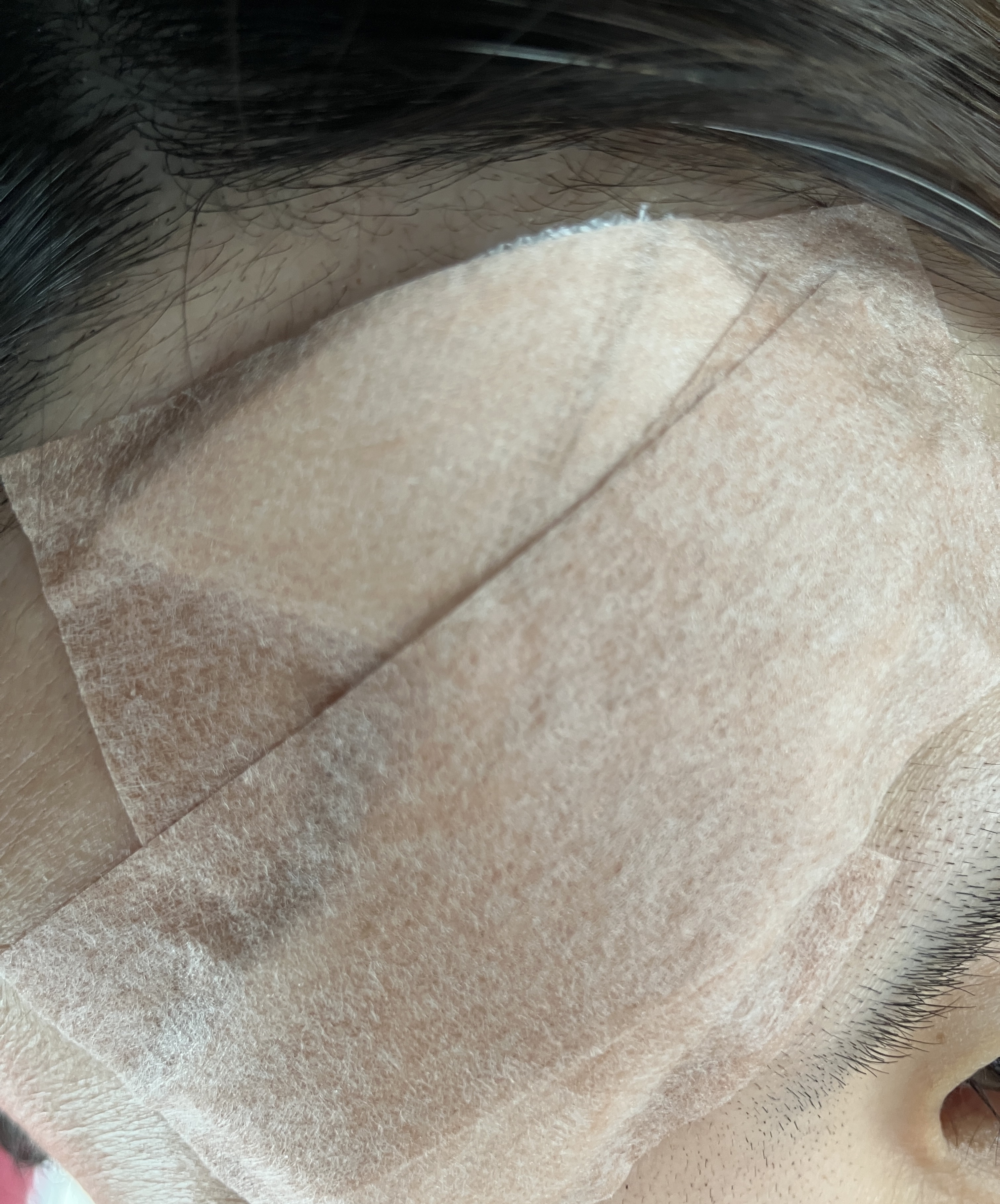 ガーゼでかいわ笑

明日、これで職場いく
大事故やん笑

粉瘤とってきました！
ガーゼ外れるのは2-3日？