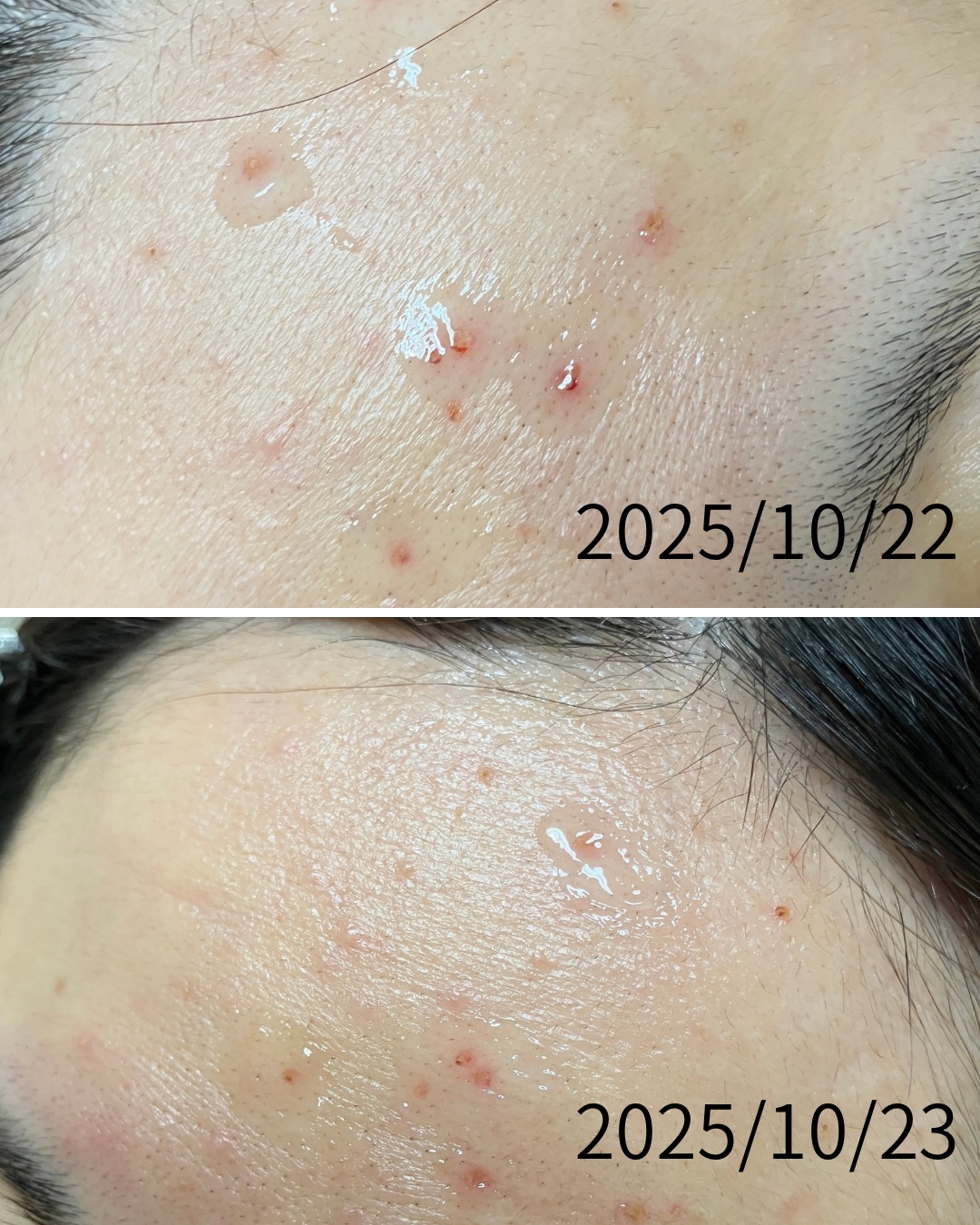 術後2日が経過しました。
ひたすらかゆいです。
良くなってる気配は全然感じません。
とりあえず痒いです。
ガーゼもう貼らなくてもいいような気がするんだけど、ガーゼ貼っとかないと掻きむしりそうなので、今日もでっかいガーゼ貼ってきます（恥）
来