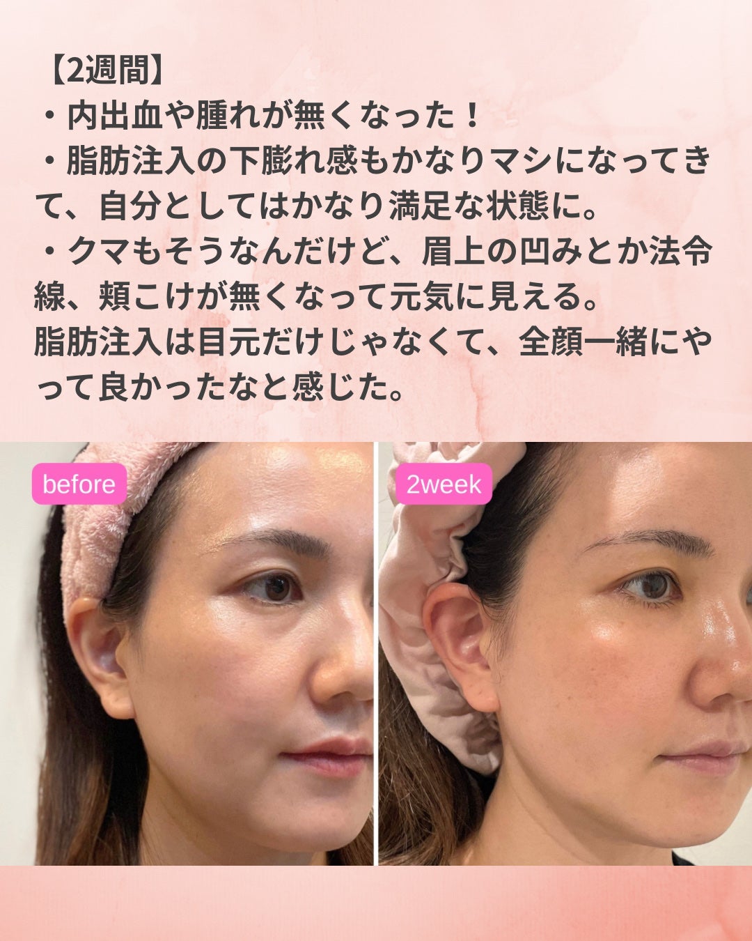 373@フォロバ→投稿ある方 on LIPS 「クマ取り(脱脂)&脂肪注入3ヶ月レポート️📝やっと脂肪が定着す..」(8枚目)