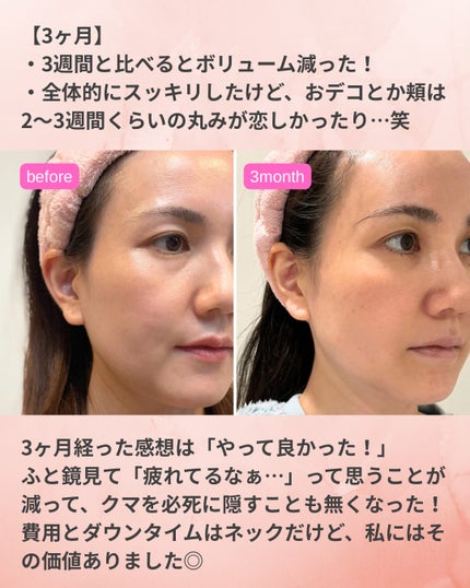 373@フォロバ→投稿ある方 on LIPS 「クマ取り(脱脂)&脂肪注入3ヶ月レポート️📝やっと脂肪が定着す..」(10枚目)