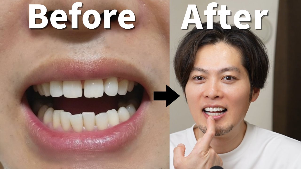 矯正って痛い・面倒・高いって思ってたけどマウスピース矯正を体験して思ってたのと違った。装着するだけでこんなに歯が動くのかとびっくりしたけど、施術前と比べるとかなり印象が変わってて、前歯って大事なんだなって思いました。週1でマウスピースを交換