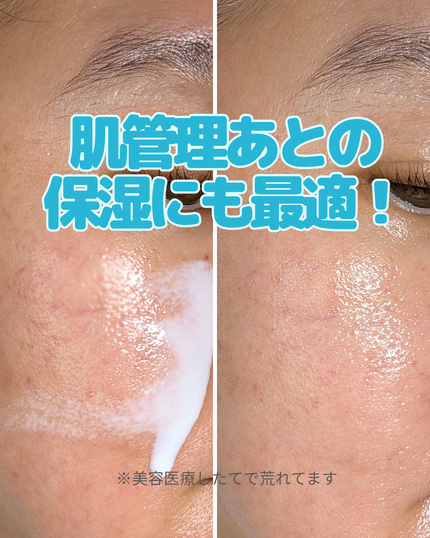 リードルS PDRN+ セラム/VT/美容液を使ったクチコミ(3枚目)