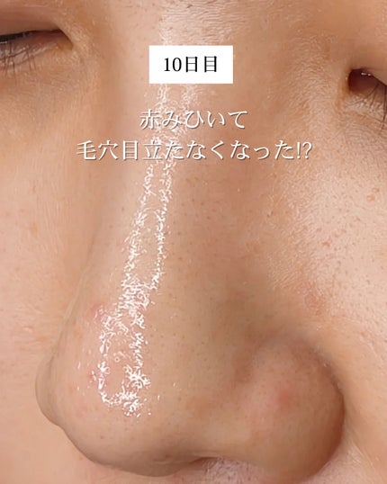 アネトス アクネケア トリートメント セラム/Anetos/美容液を使ったクチコミ(6枚目)