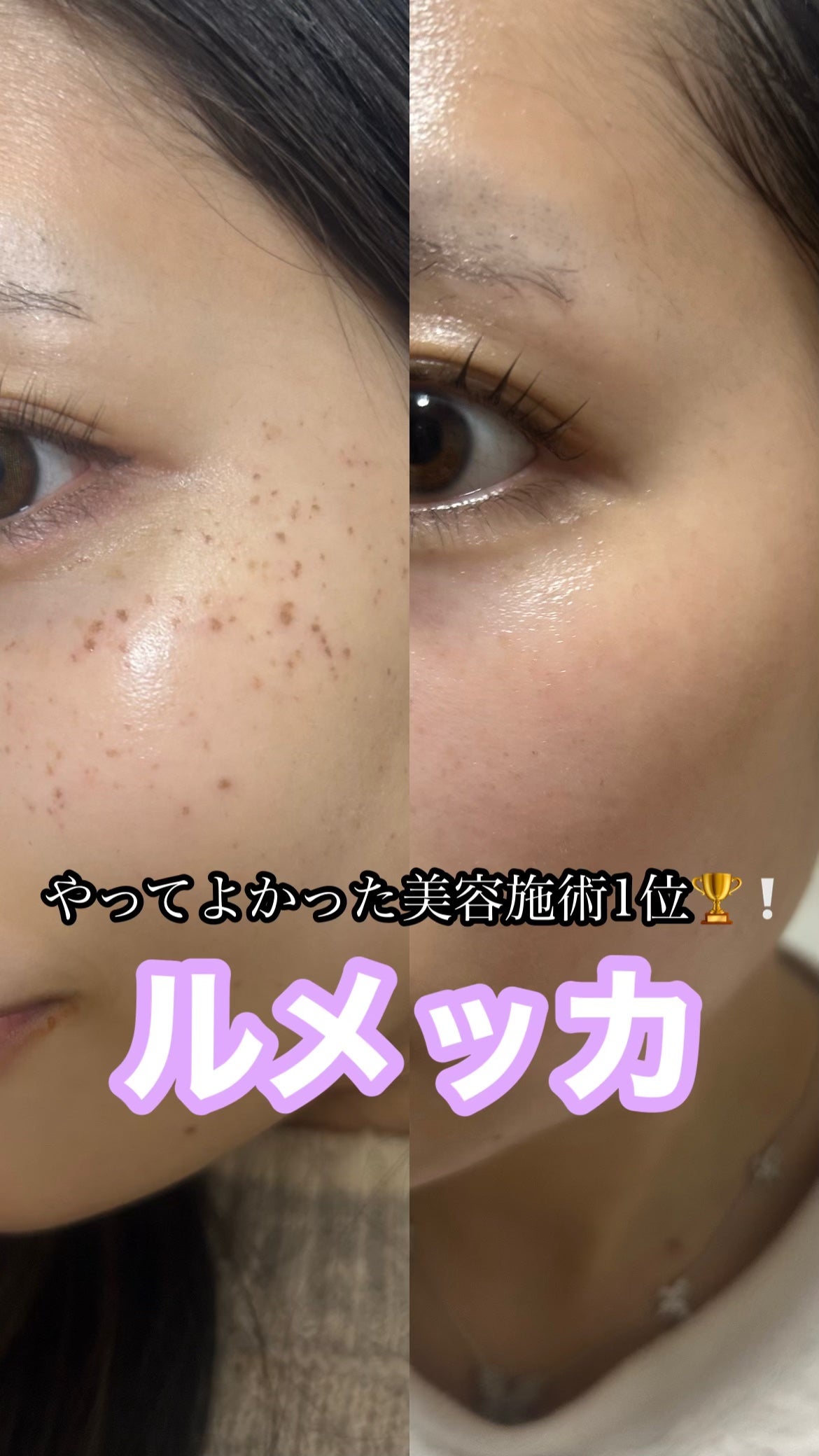 ちゃーちー on LIPS 「#ルメッカ#フォトフェイシャル#シミ#そばかす#はじめての投稿..」(1枚目)