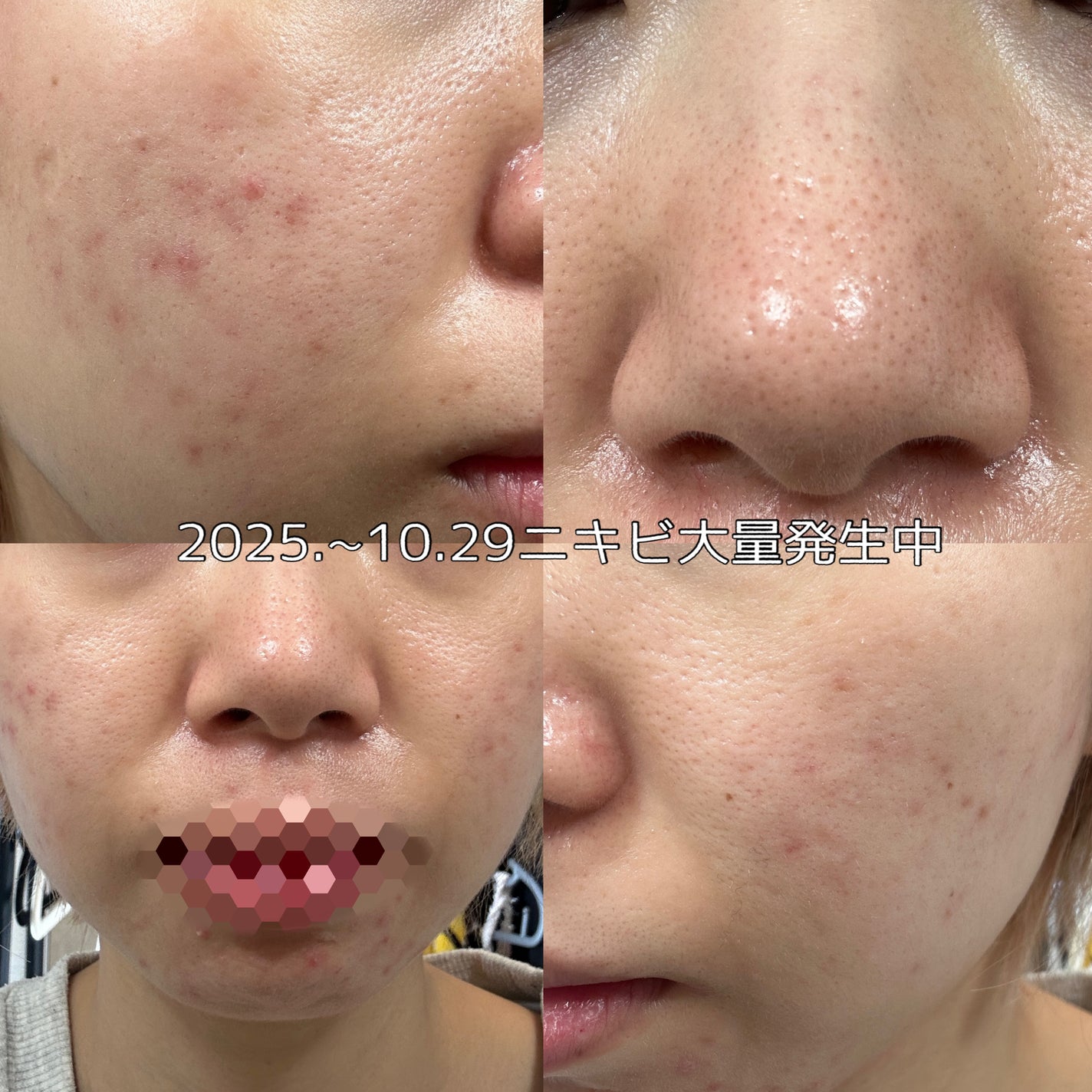 ノブ A アクネソープ/NOV/洗顔石鹸を使ったクチコミ(2枚目)