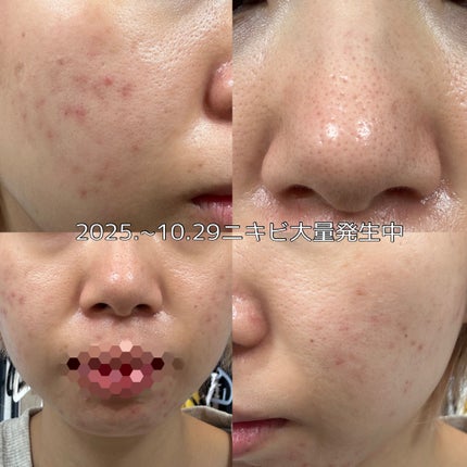 ノブ A アクネソープ/NOV/洗顔石鹸を使ったクチコミ(2枚目)