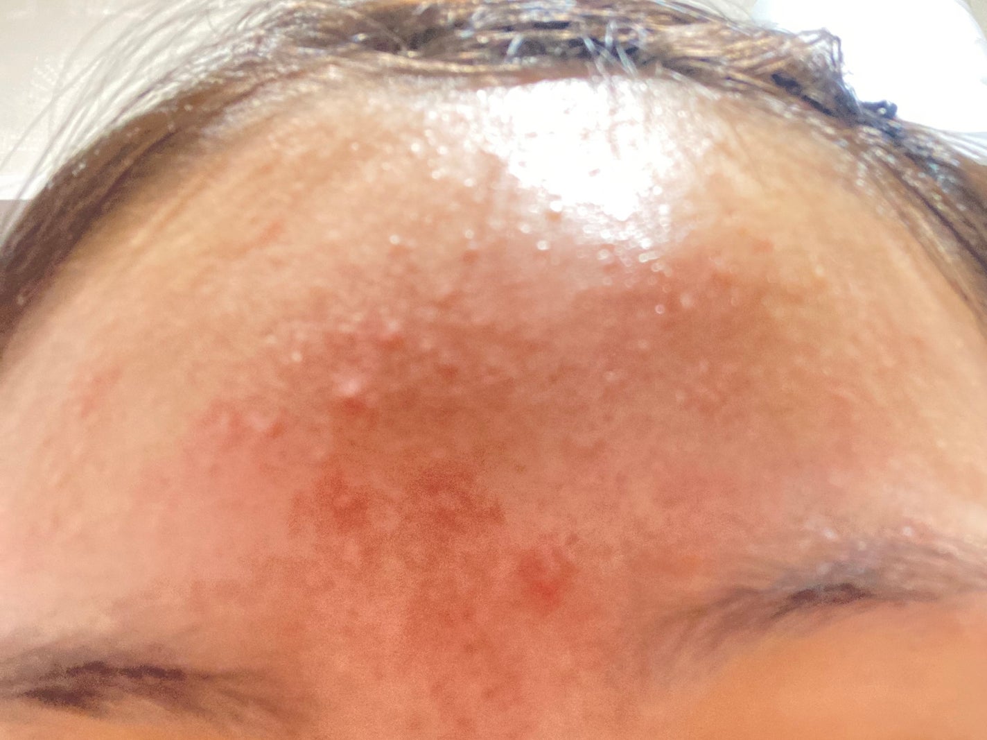 まろん on LIPS 「汚肌すいません(;_;)肌綺麗にする!同じ悩みの人頑張りましょ..」(1枚目)