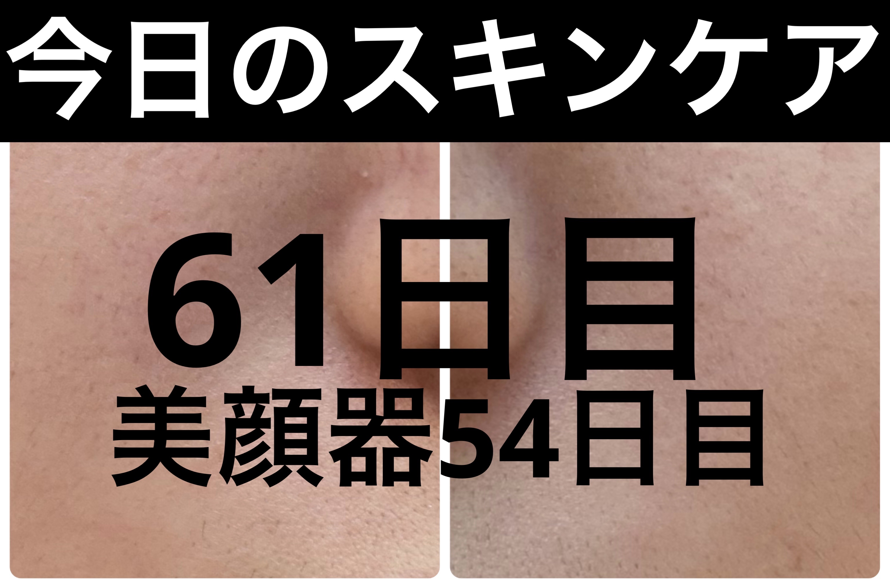 ブラックヘッドバームスクラブ/オブジェ/フェイスバームを使ったクチコミ（1枚目）