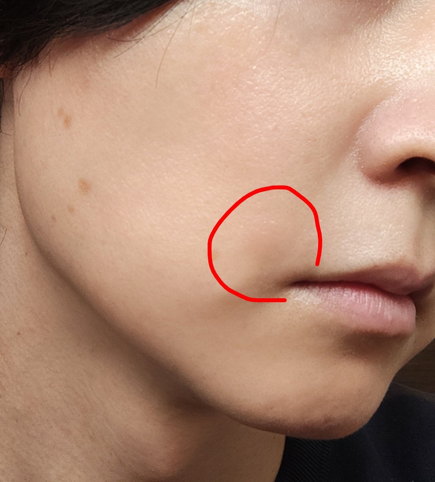 トレチノインジェル/A-Ret/美容液を使ったクチコミ(2枚目)