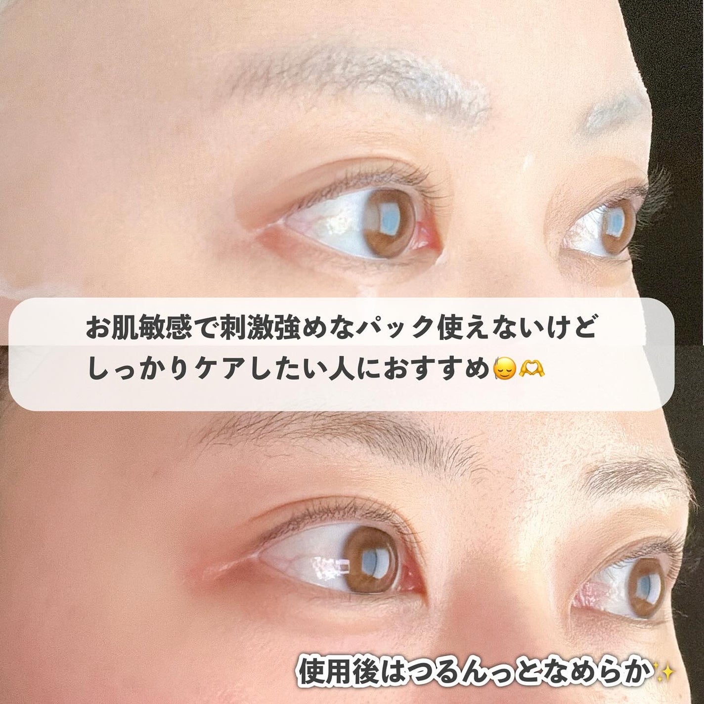 ダーマレーザー スーパーPDRN+VC100マスク/クオリティファースト/シートマスク・パックを使ったクチコミ(7枚目)