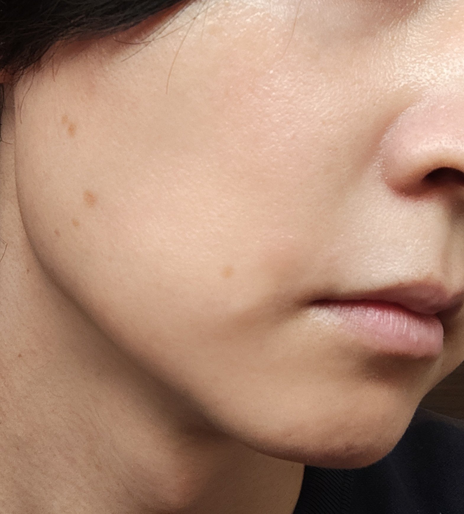 トレチノインジェル/A-Ret/美容液を使ったクチコミ（3枚目）