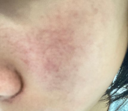 まろん on LIPS 「ちょっとだけましになりました、??白く綺麗にしたいです!どんな..」(2枚目)