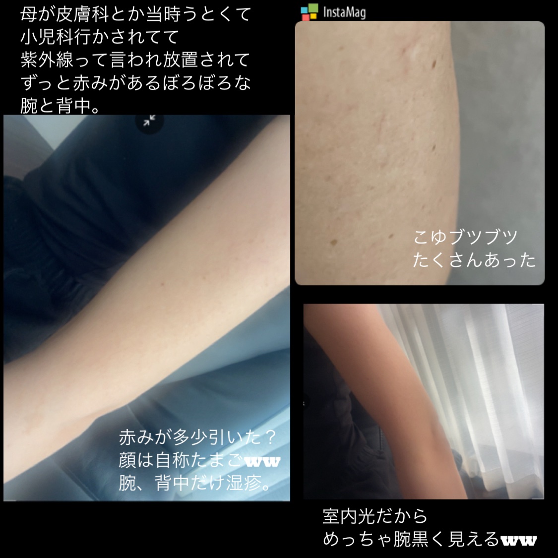 背中ニキビ用メルティングジェルクリーム ルフティグ/ODELOI/ボディクリームを使ったクチコミ（2枚目）