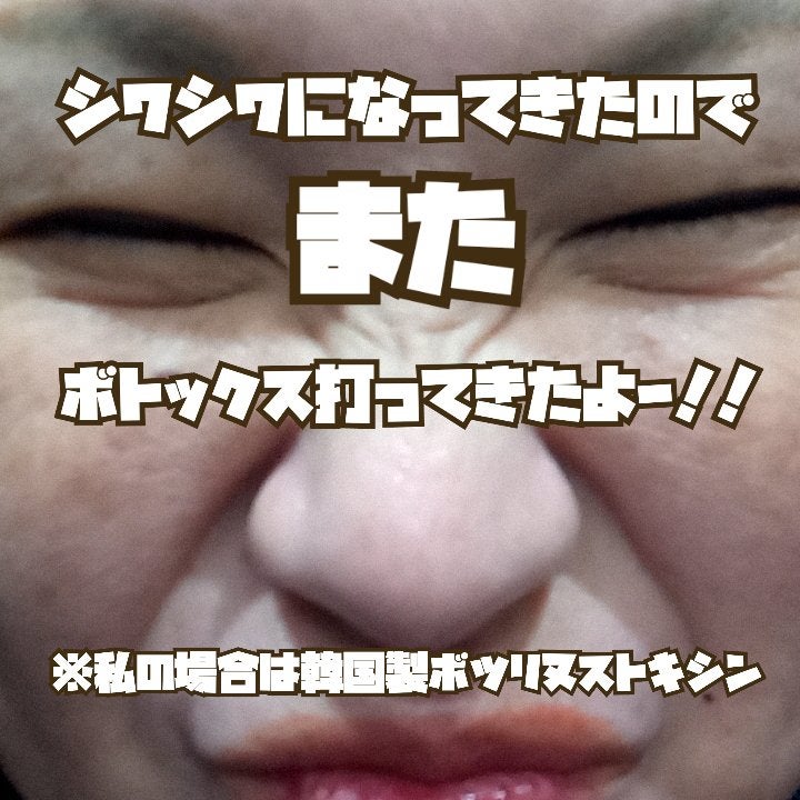 ビヨンセ奥二重向上委員長🥸LIPSパートナー🥳 on LIPS 「...3ヶ月経ったのでまたボトックス打ってきました!!※私の場..」(1枚目)