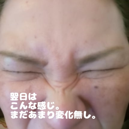 ビヨンセ奥二重向上委員長🥸LIPSパートナー🥳 on LIPS 「...3ヶ月経ったのでまたボトックス打ってきました!!※私の場..」(5枚目)