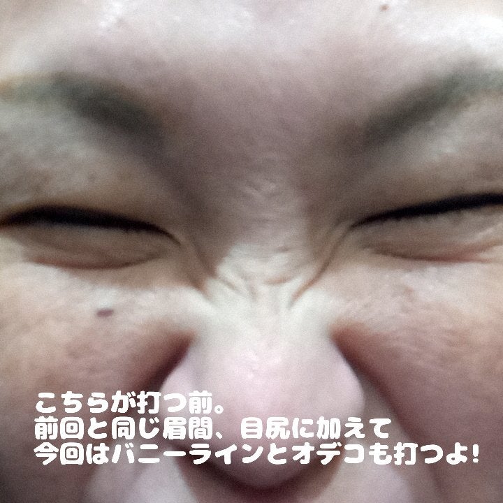 ビヨンセ奥二重向上委員長🥸LIPSパートナー🥳 on LIPS 「...3ヶ月経ったのでまたボトックス打ってきました!!※私の場..」(2枚目)