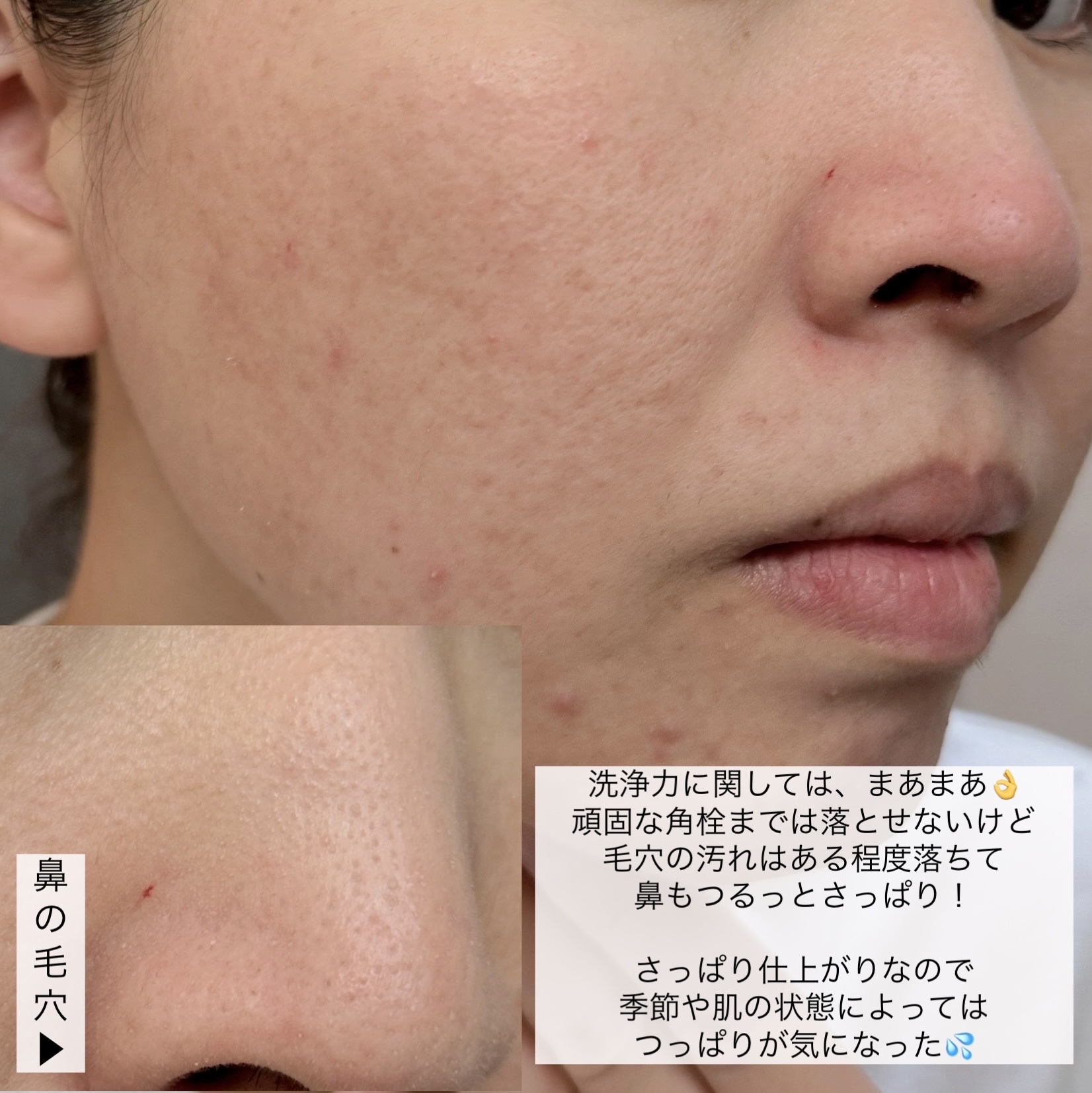 ACNE REPAIR GENTLE MICRO CLEANSER/NIVEA(海外)/洗顔フォームを使ったクチコミ（3枚目）