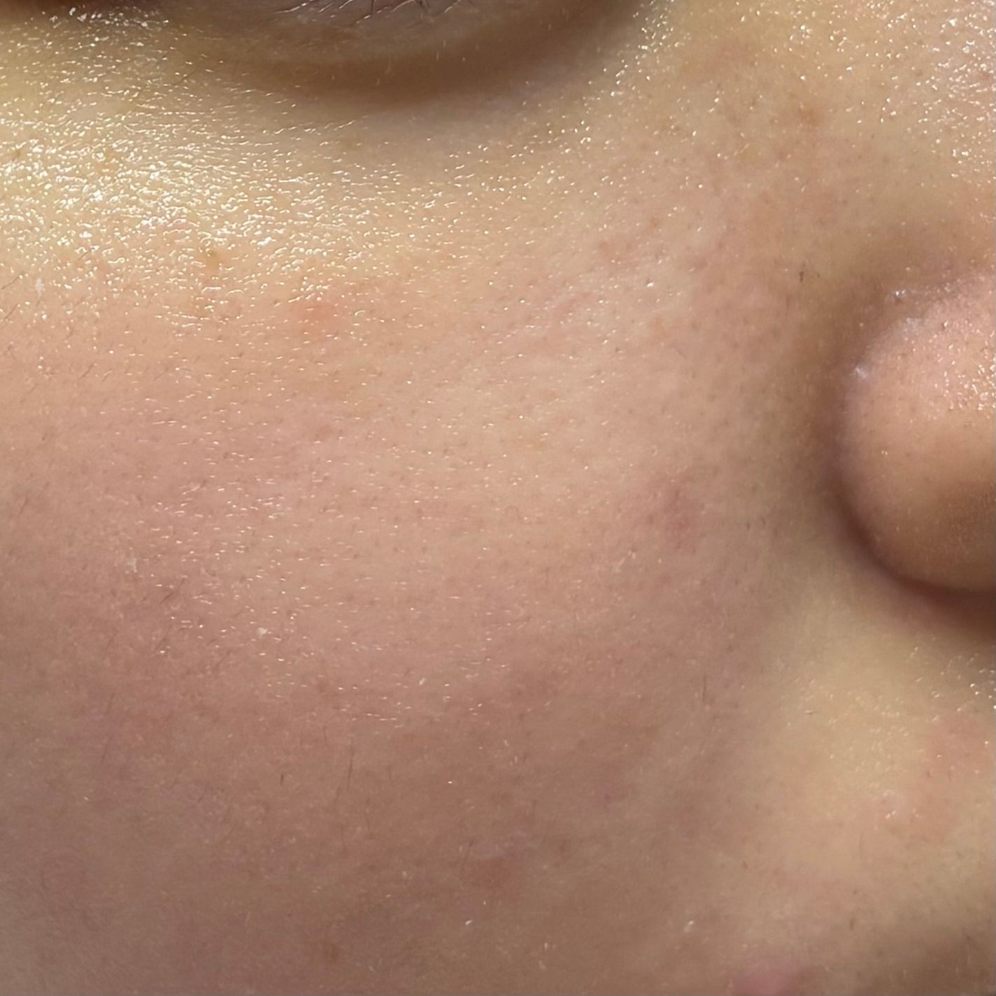 瞬き on LIPS 「にきび記録4日目ですが最後にします!まぁ、このまま消えるだろう..」(6枚目)