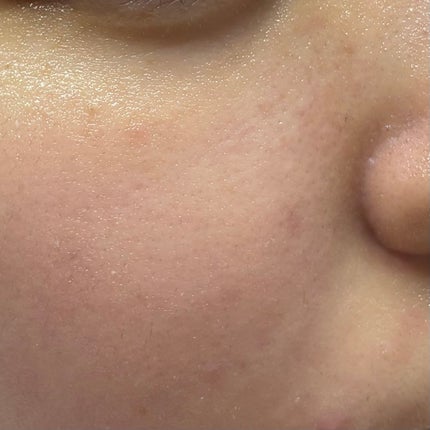 瞬き on LIPS 「にきび記録4日目ですが最後にします!まぁ、このまま消えるだろう..」(6枚目)