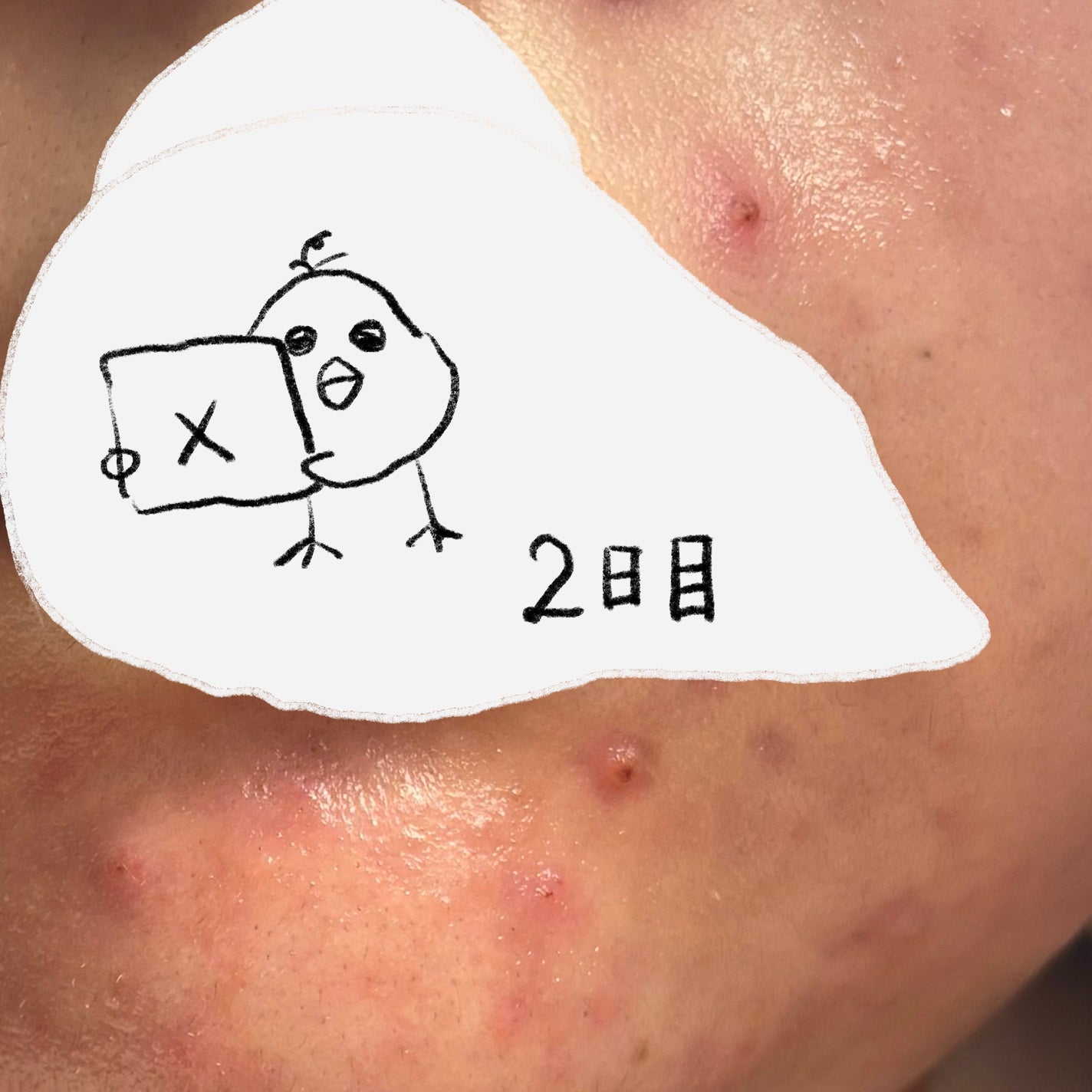 瞬き on LIPS 「にきび記録4日目ですが最後にします!まぁ、このまま消えるだろう..」(3枚目)