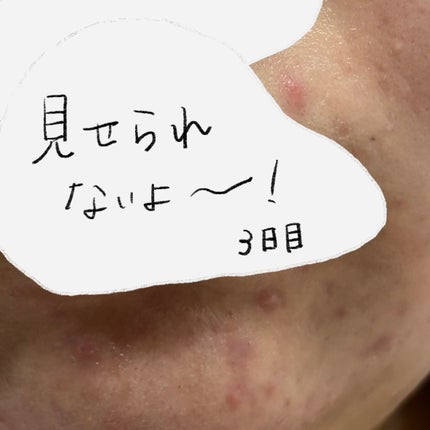 瞬き on LIPS 「にきび記録4日目ですが最後にします!まぁ、このまま消えるだろう..」(4枚目)