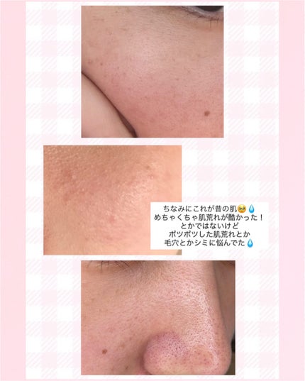 ãŽã£ãŒã¬ã³ãªããœãŒã ã¬ãããŒã«ã»ã©ã /SKIN&LAB/çŸå®¹æ¶²ã䜿ã£ãã¯ãã³ãïŒ2æç®ïŒ