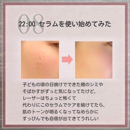 アネトス アクネケア トリートメント セラム/Anetos/美容液を使ったクチコミ(9枚目)