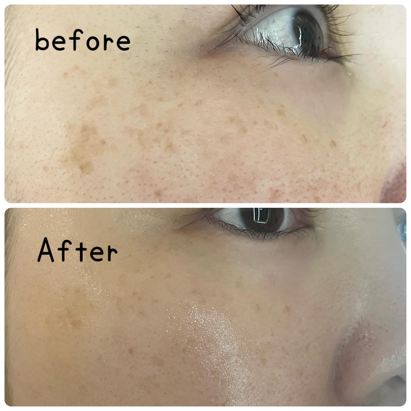  HAKU メラノフォーカスIV/HAKU/美容液を使ったクチコミ（3枚目）