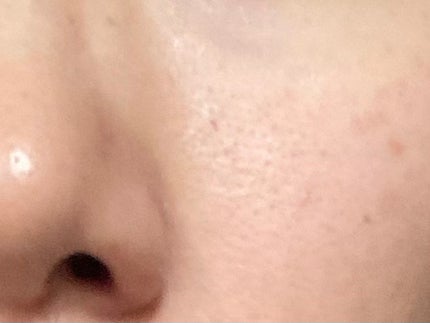 アゼライン酸15 インテンスカーミングセラム/Anua/美容液を使ったクチコミ(1枚目)