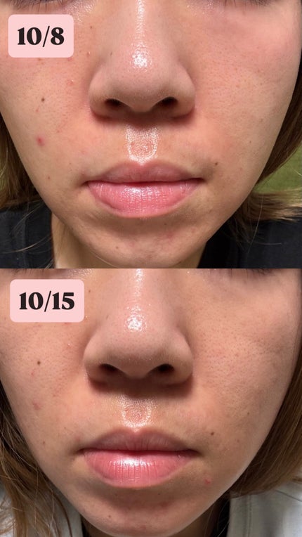 3ã»ã©ãããã³ãããŒã«ã¢ã€ã¹ãã£ãŒããªã¢ã¯ãªãŒã /Anua/ãã§ã€ã¹ã¯ãªãŒã ã䜿ã£ãã¯ãã³ãïŒ2æç®ïŒ