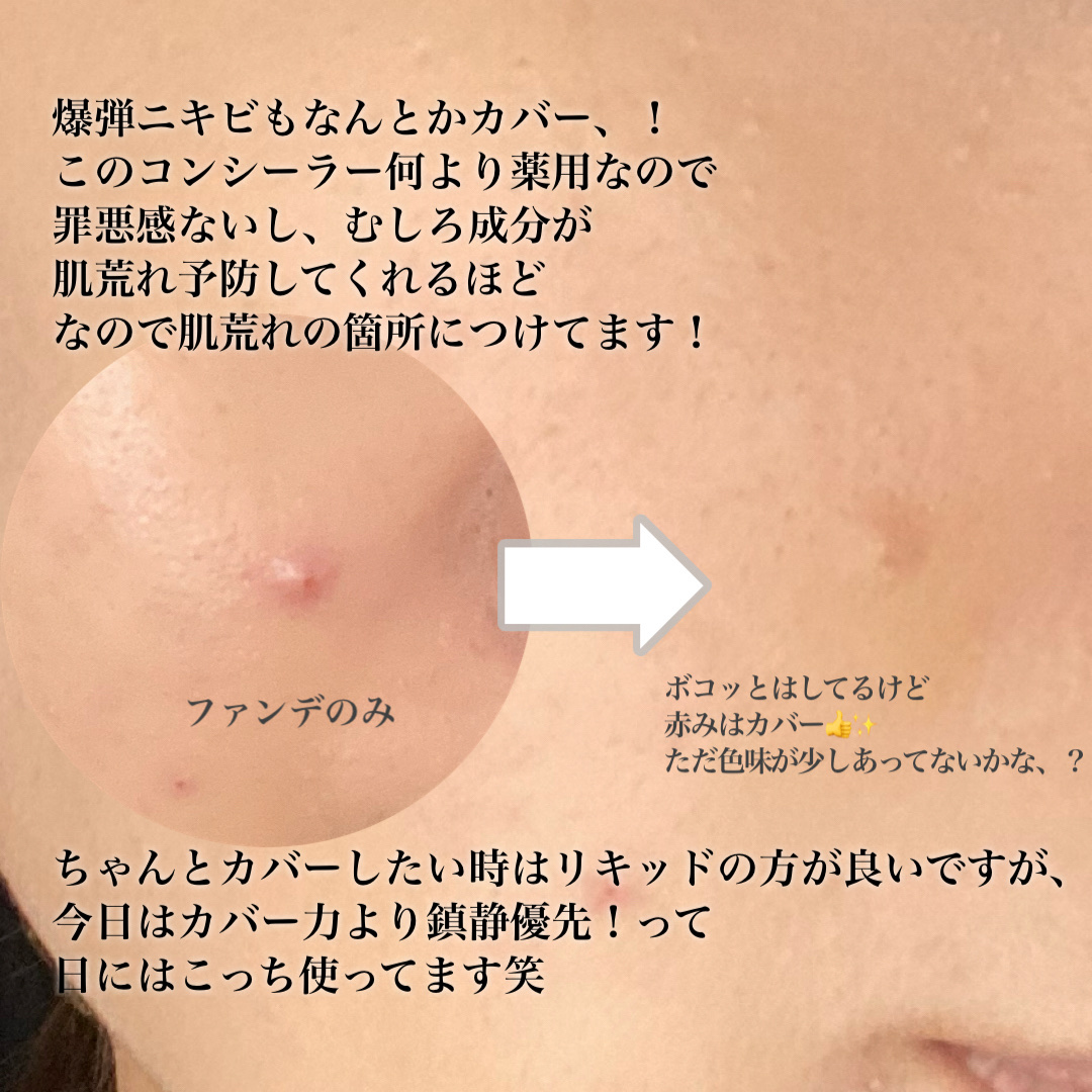 薬用コンシーラー アクネプロテクター/ONLY MINERALS/パウダーコンシーラーを使ったクチコミ（3枚目）