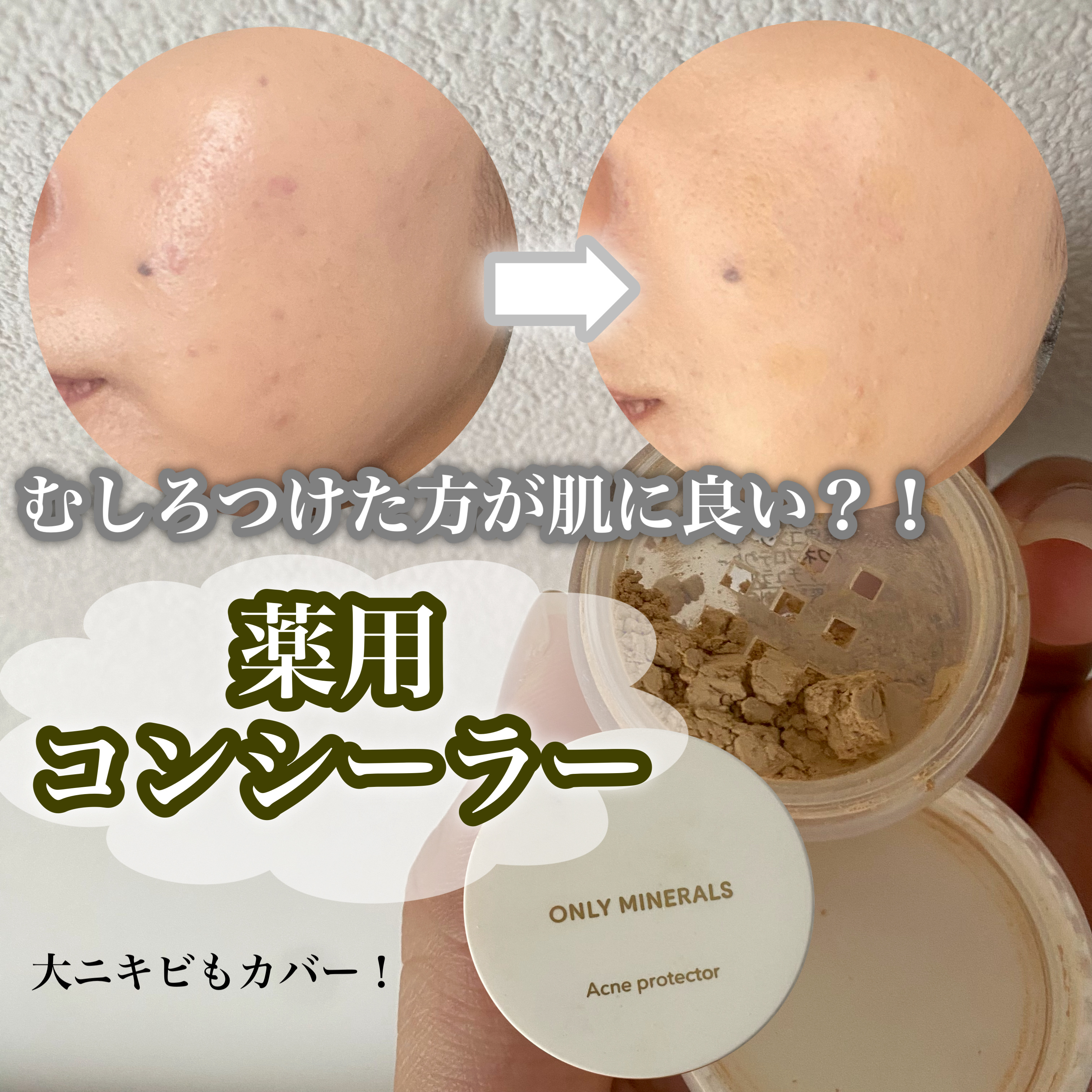 薬用コンシーラー アクネプロテクター/ONLY MINERALS/パウダーコンシーラーを使ったクチコミ（1枚目）