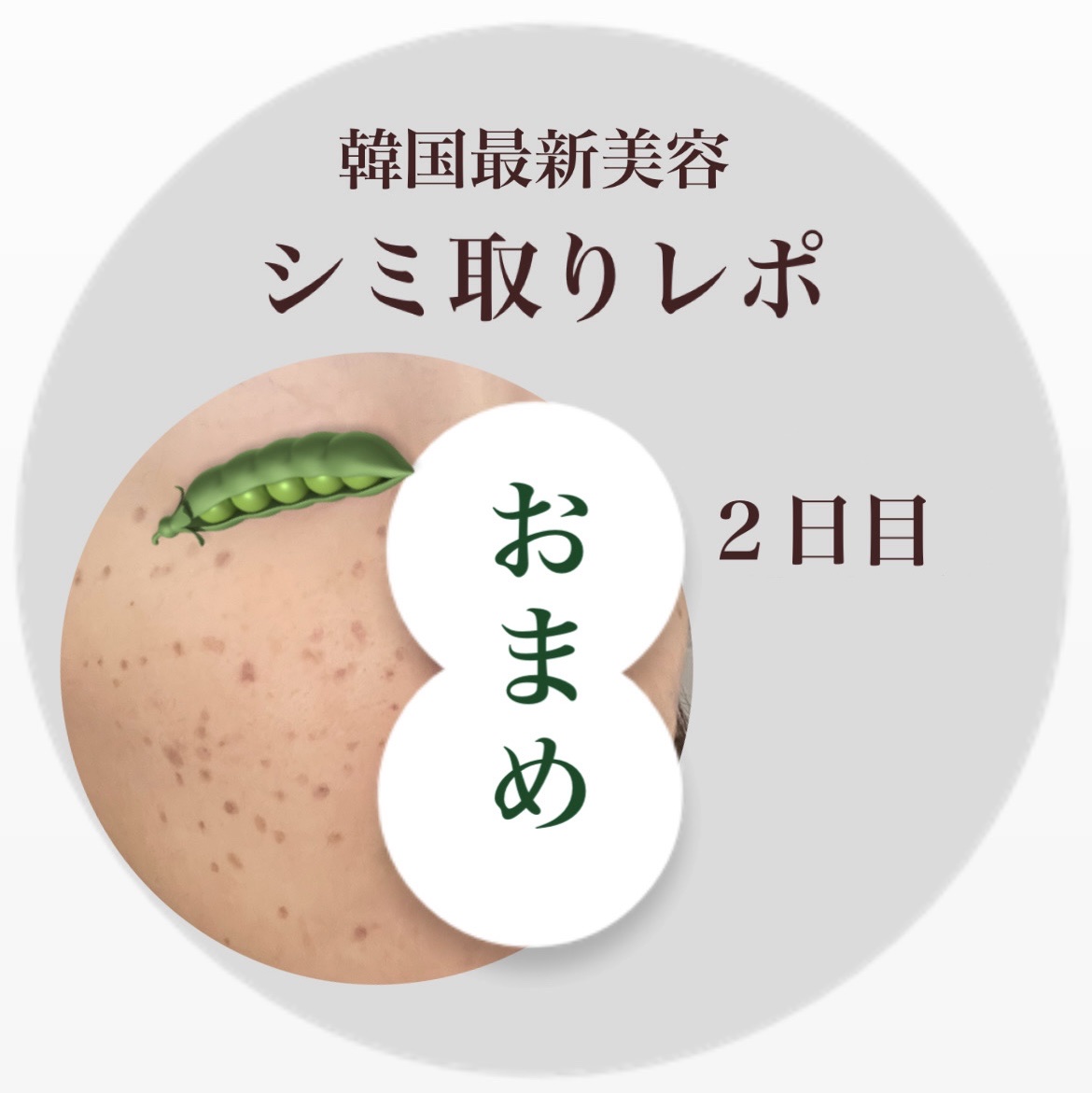 コスメとは関係ありませんが🙇🏻‍♀️


シミ取り経過レポ💫２日目💫

赤みも落ち着いて茶色っぽく
なってきました🤎

夜はワセリンを塗り塗りしてます！

#シミ取り #全身うるおい強化週間 