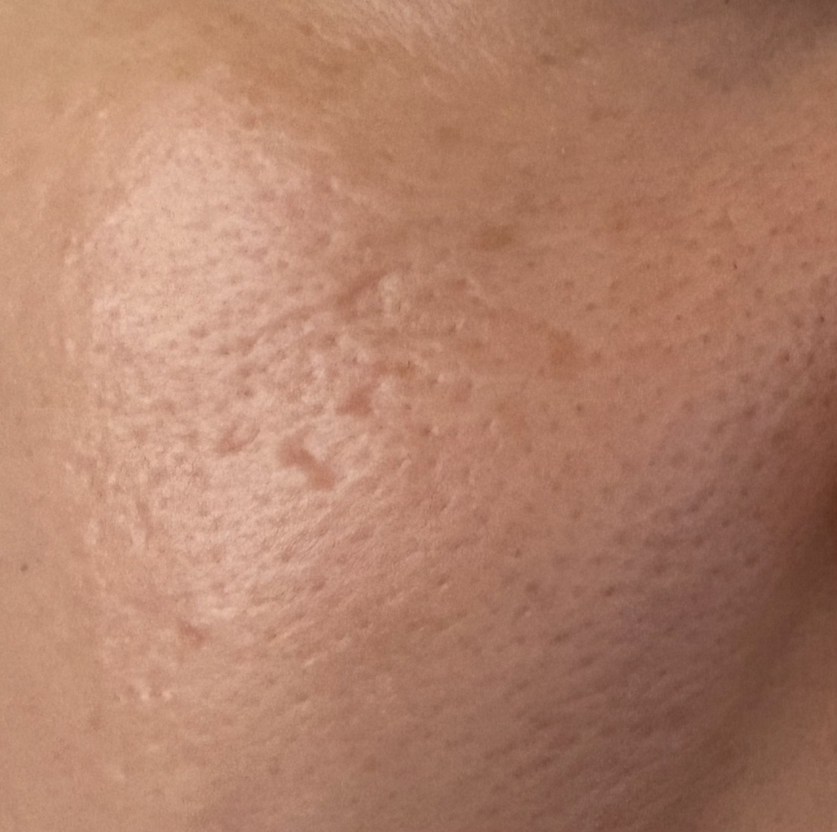 レチA リードルショット100 50ml/VT/ブースター・導入液を使ったクチコミ（2枚目）