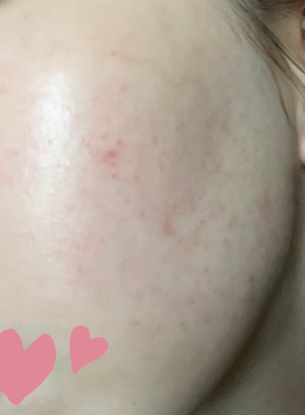 マキロン アクネージュ メディカルクリーム (医薬品) /マキロン/その他を使ったクチコミ(2枚目)