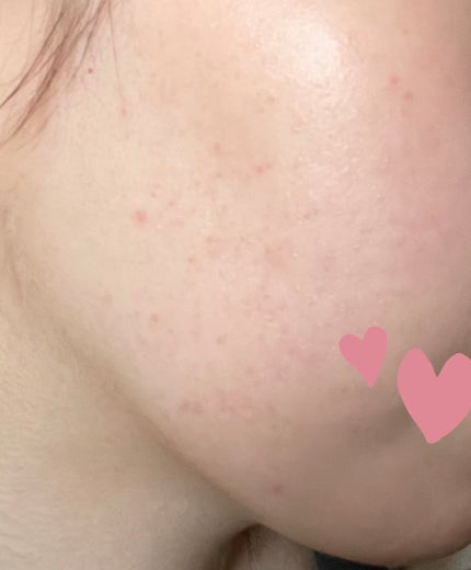 マキロン アクネージュ メディカルクリーム (医薬品) /マキロン/その他を使ったクチコミ(3枚目)