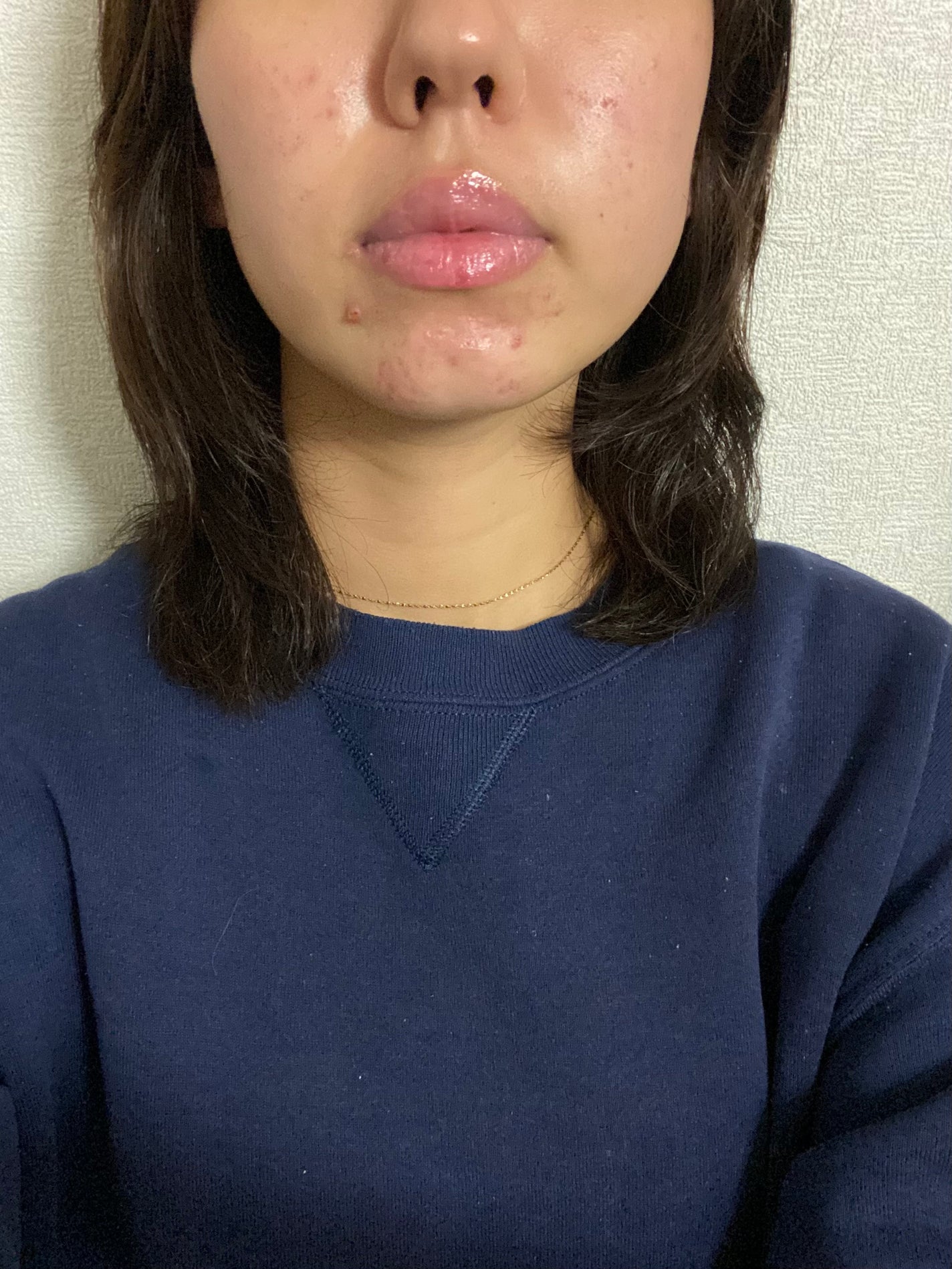 み on LIPS 「だいぶサボってました、、すみませんイソトレチノイン飲み始めて約..」(1枚目)
