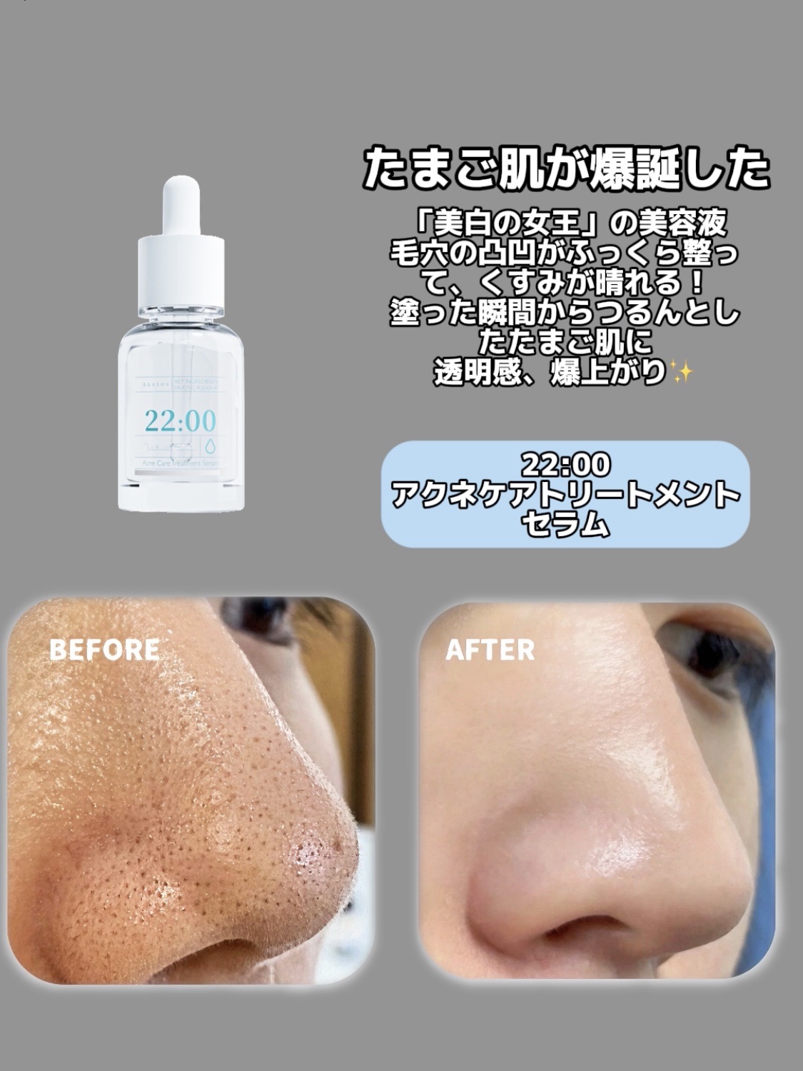 アネトス アクネケア トリートメント セラム/Anetos/美容液を使ったクチコミ（2枚目）