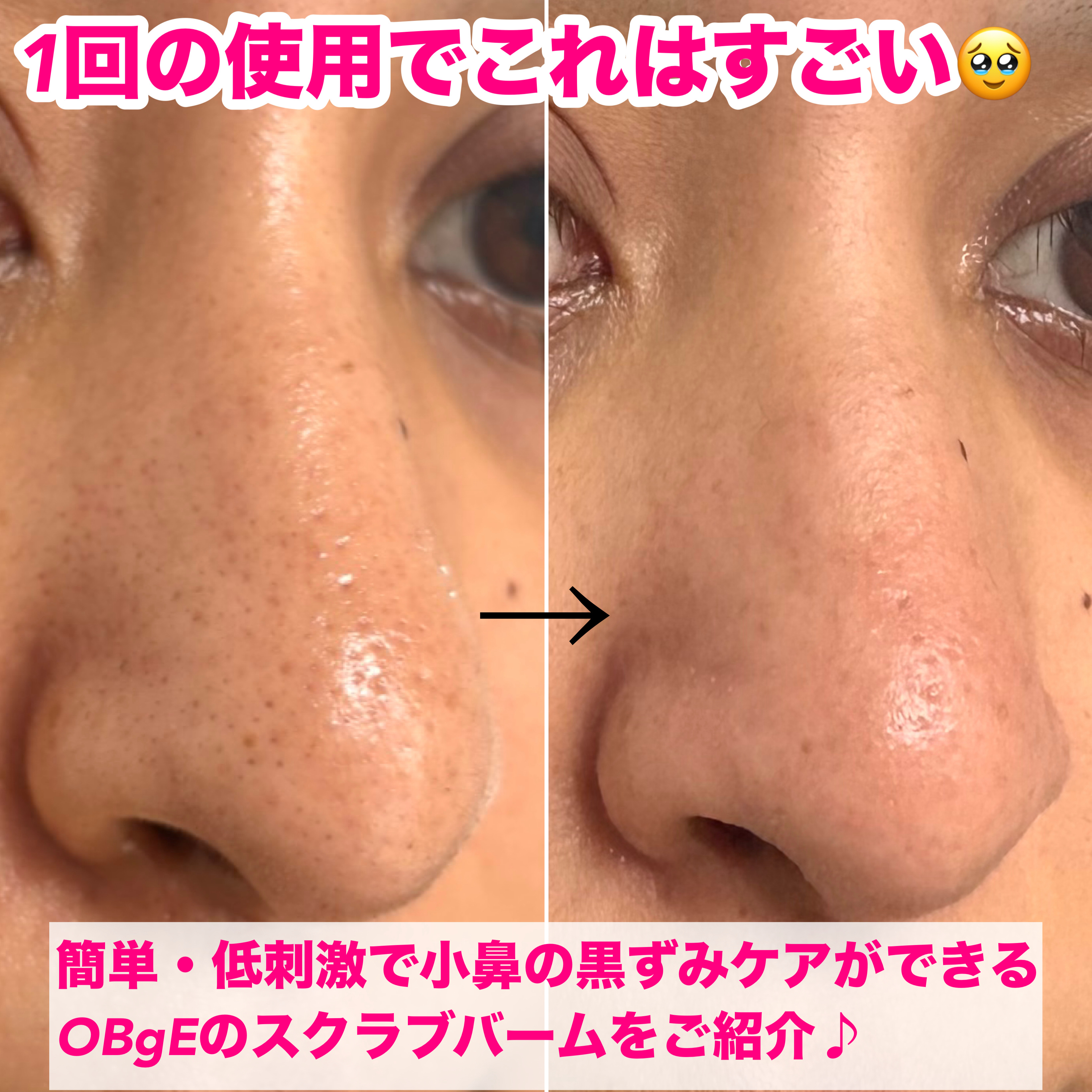 ブラックヘッドバームスクラブ/オブジェ/フェイスバームを使ったクチコミ（2枚目）