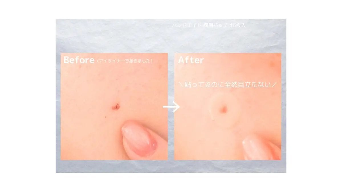 バンドエイド 顔用パッチ/バンドエイド/その他を使ったクチコミ(3枚目)