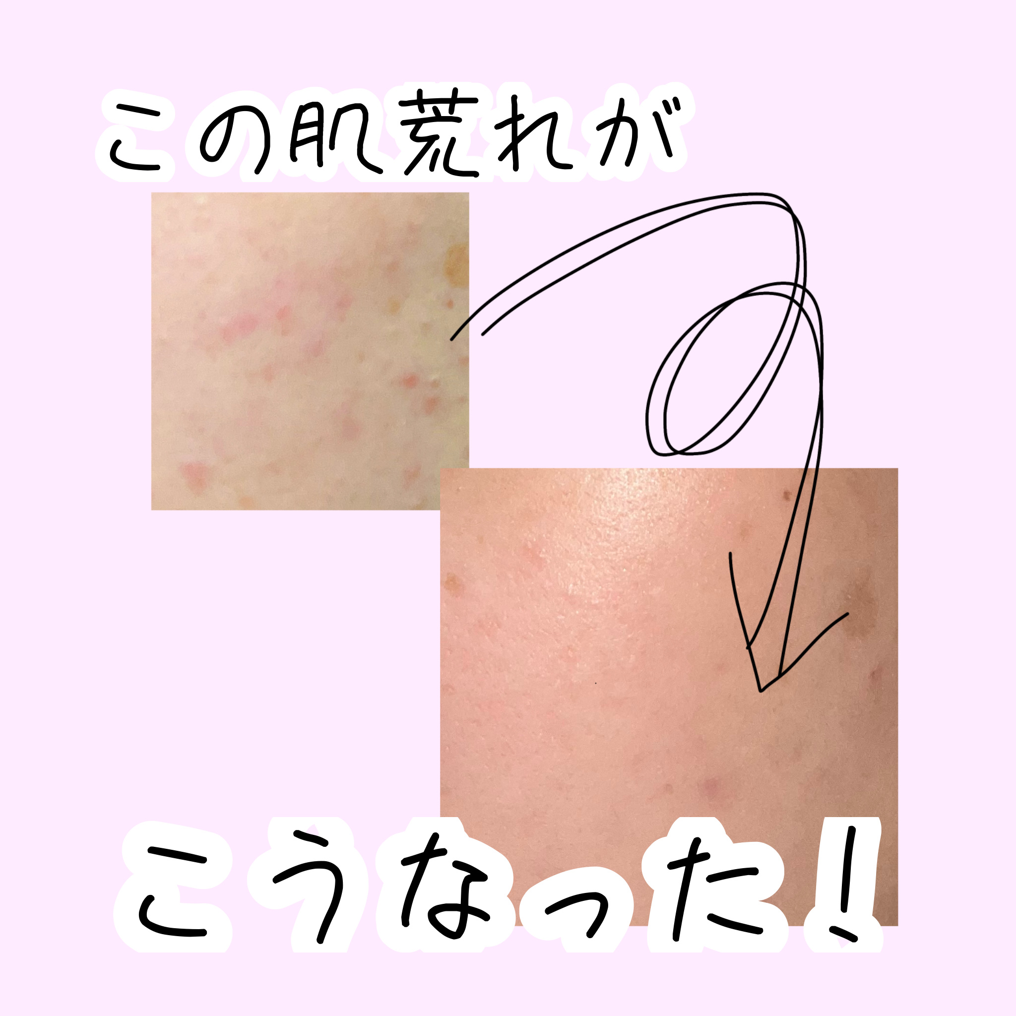 ペアアクネクリームW(医薬品)/ペア/その他を使ったクチコミ（1枚目）